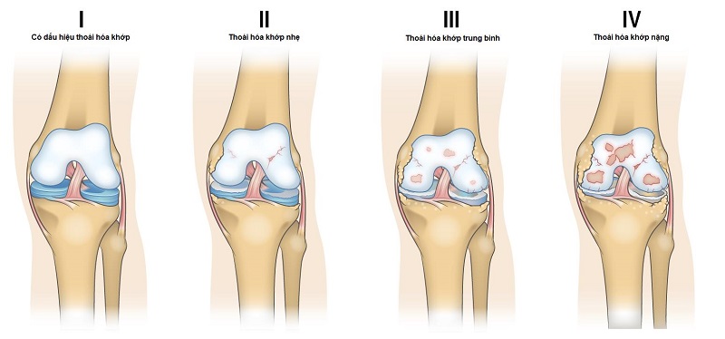 What is Osteoarthritis?