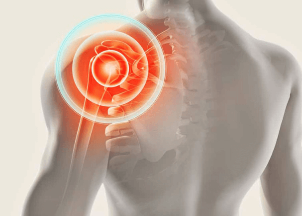 Common Causes of Shoulder Pain and Inability to Raise Your Arm